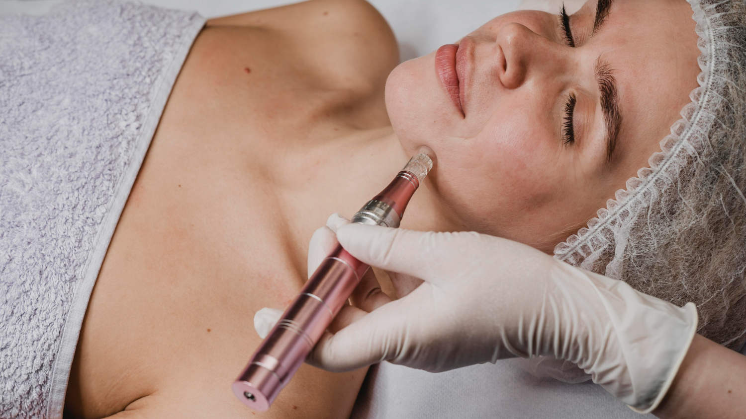 Microneedling-behandling med eksosomer